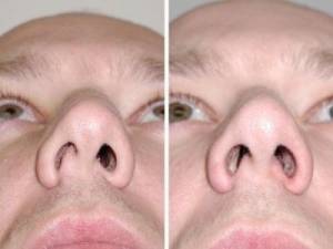Как вылечить длительную заложенность носа thumbnail