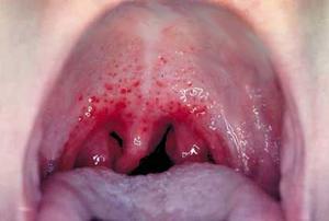 Причины болей в горле с белым налетом thumbnail