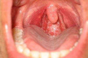 Стафилококк и стрептококк в горле 14