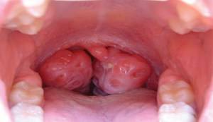 Фото больного горла с описанием болезни thumbnail