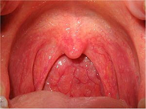 Болит горло отдает в уши кашель thumbnail