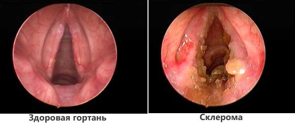 Инфекционные болезни горла и гортани фото и симптомы thumbnail