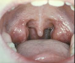 Болит миндалина отдает в ухо и зубы thumbnail